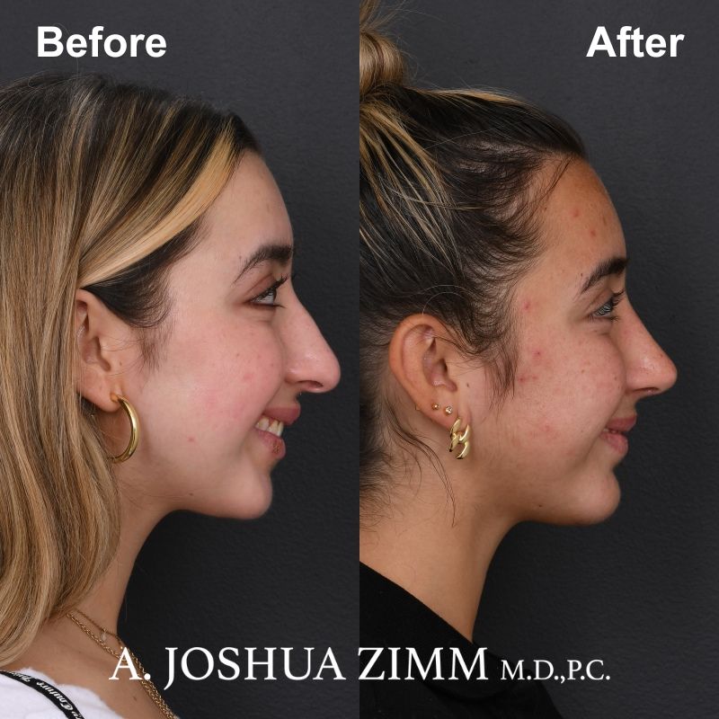 Rhinoplasty - before and after