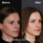 Rhinoplasty - before and after