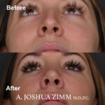 Rhinoplasty - before and after