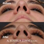 Rhinoplasty - before and after