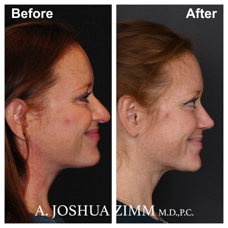 Rhinoplasty - before and after