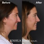 Rhinoplasty - before and after