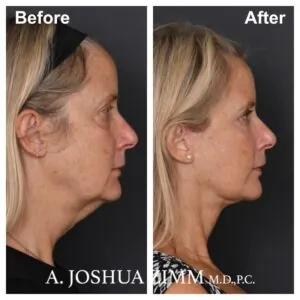 Facelift - before and after